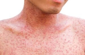 Salud Pública emite alerta epidemiológica por sarampión